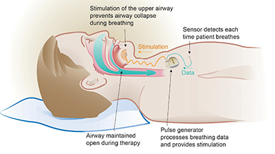 Inspire Therapy Implantable upper airway stimulation device 