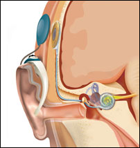 Illustration of cochlear implant
