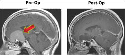 Head scan before and after surgery