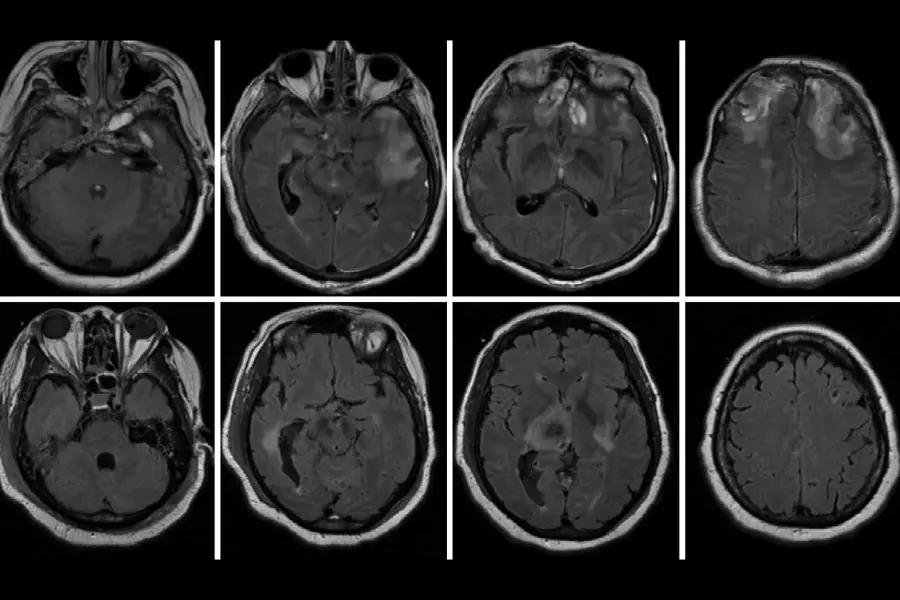 Brain MRI scans of two CMD patients