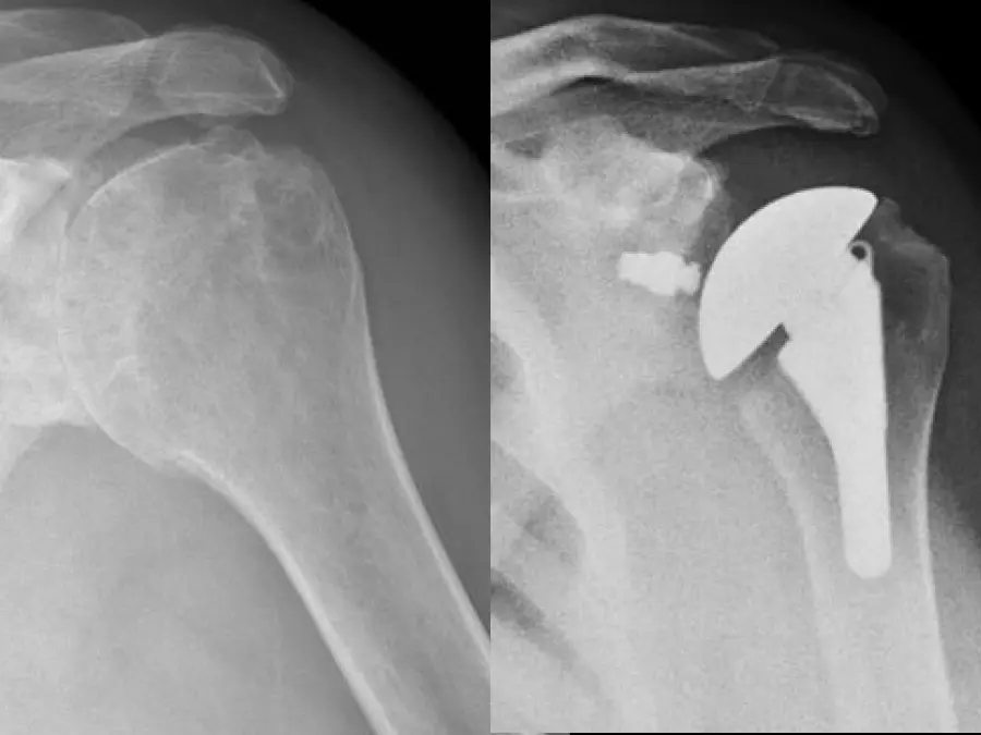 Left: Pre-operative image of shoulder before total shoulder arthroplasty. Right: Post-operative image showing the new prosthesis in place.