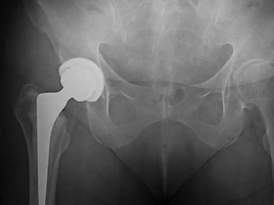 Image of a cemented femoral stem in total hip arthroplasty