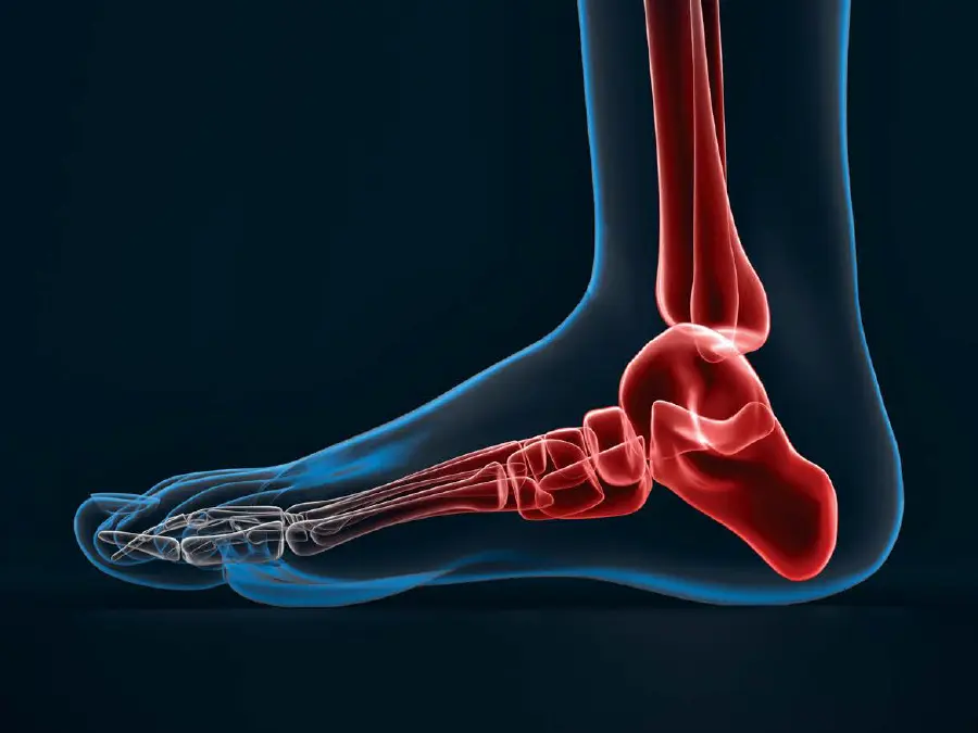 Lateral view of the ankle, which has a higher rate of PJI post-arthroplasty at 3-5%.