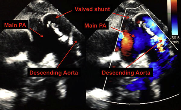 echocardiogram image of shunt in heart