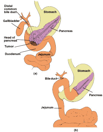 Multidisciplinary Treatment of Pancreatic Diseases | Center for ...