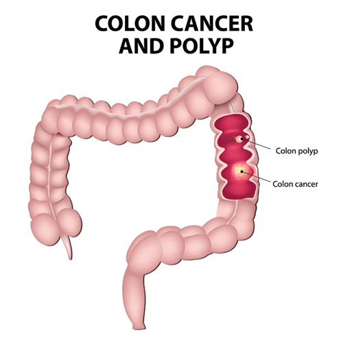 Cologuard: A New Test For Reducing The Risk Of Colon Cancer | Cancer ...