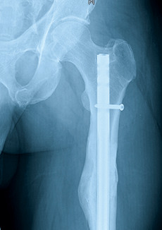 left femoral shaft fracture x-ray