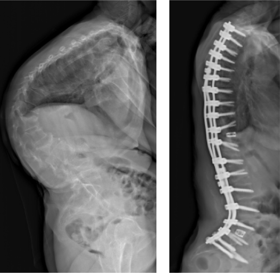 Before and After Kyphosis Surgery