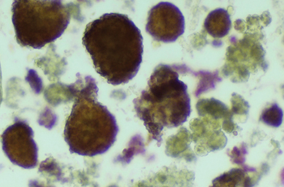Hematoxylin and eosin stain of sample from islet chamber