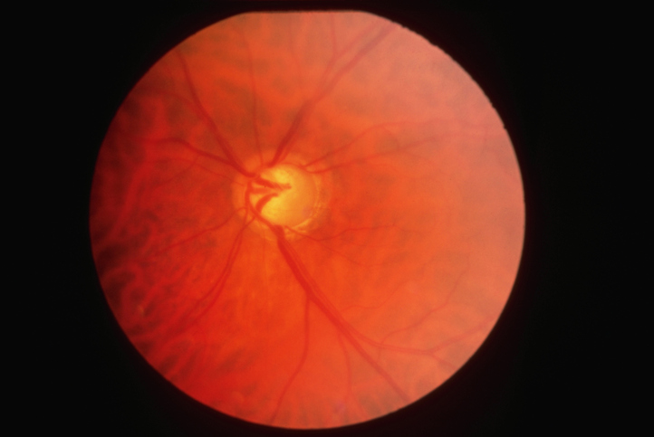 image of glaucoma in the eyes