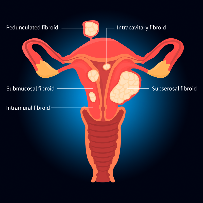 Uterine Fibroids Symptoms And Causes Newyork Presbyterian