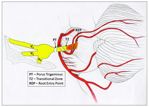 Diagram of trigeminal neuralgia surgery