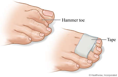 Treatment for Hammertoes