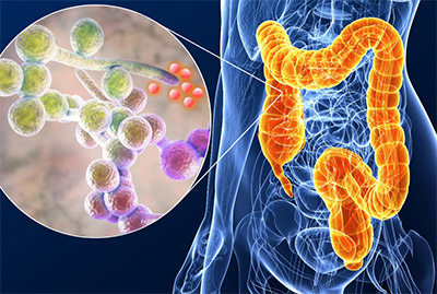 3D illustration vector image of Candida albicans strain in the colon