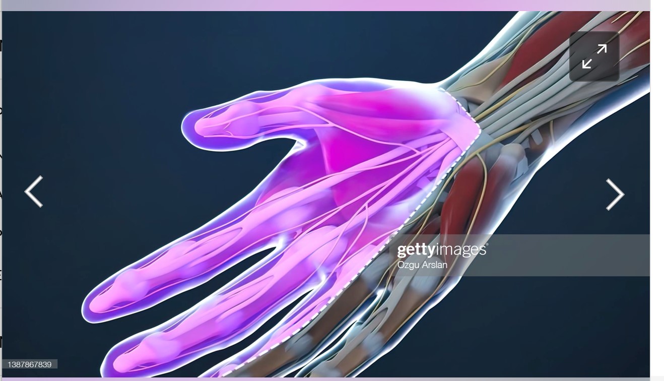 Illustration showing areas affected by carpal tunnel syndrome