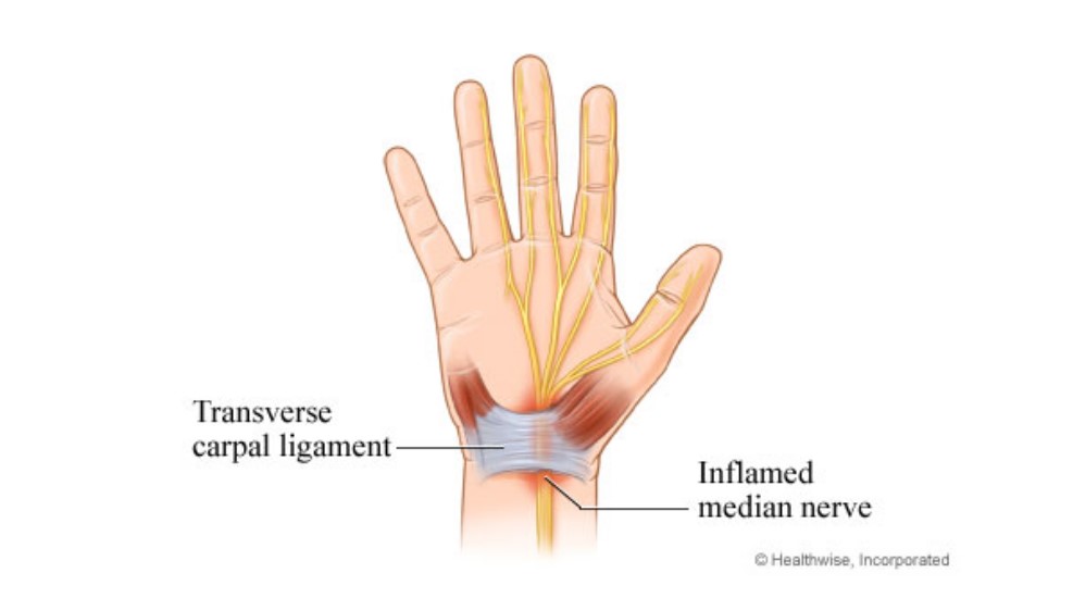 An artistic depiction of carpal tunnel syndrome