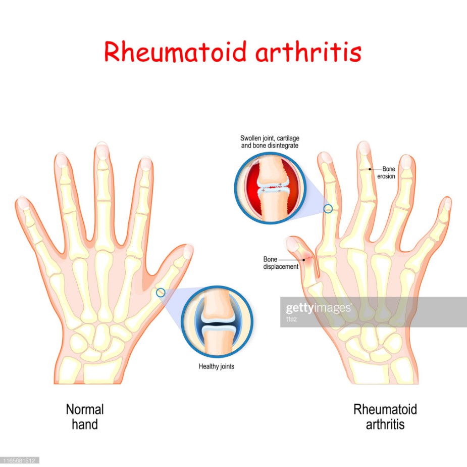 An artistic depiction of rheumatoid arthritis.