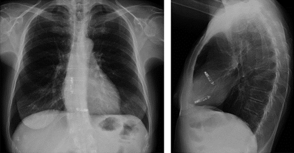chest xray images
