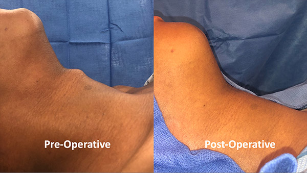 image of pre and post op neck photos