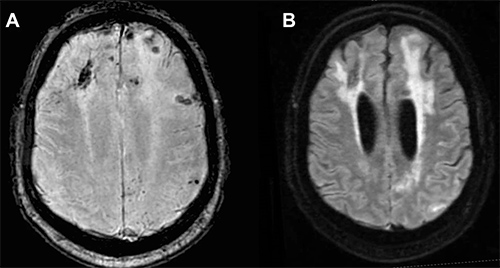 image of MRI scans of a patient with CAA