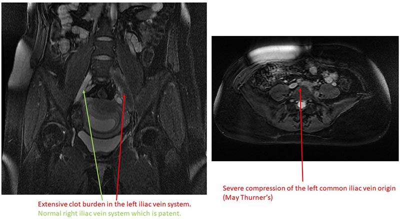 Intrauterine blood clot  Radiology Reference Article