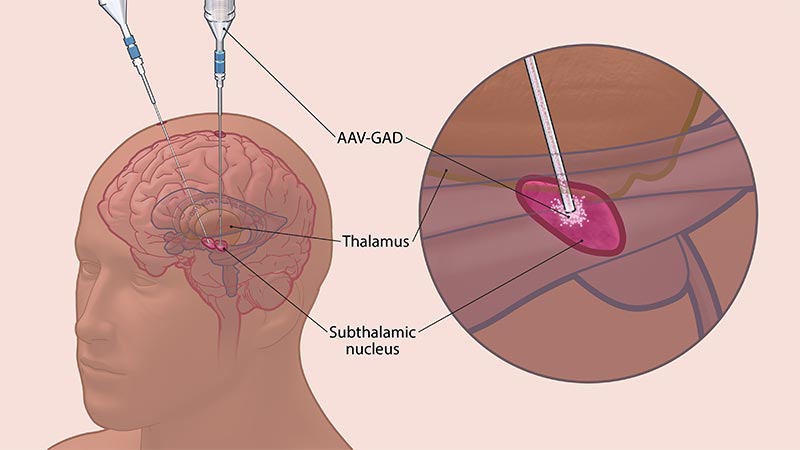 digital illustration of catheter infusion to subthalamic nucleus in the brain