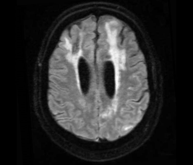 MRI showing the imaging signature of CAA-ri