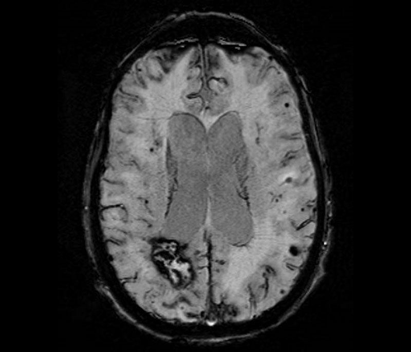 MRI showing multiple imaging hallmarks of CAA