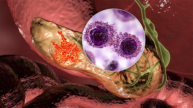 Tumor of the pancreas with close-up view of cancer cells