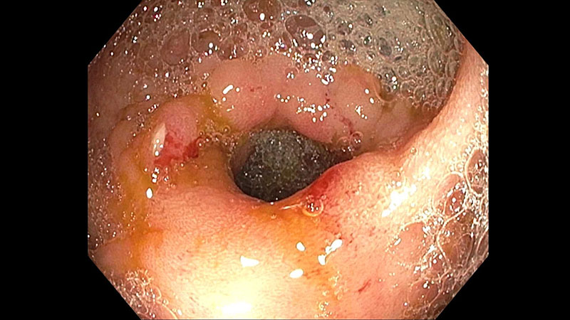 Intestinal stenosis as seen during endoscopy