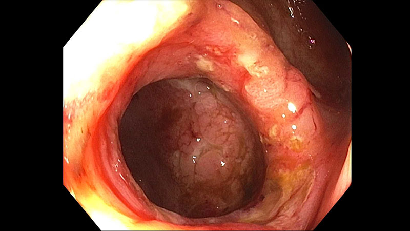 Stricture resolved following EIT