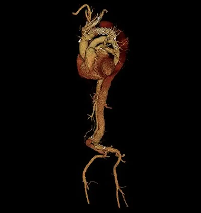 3D reconstructed image from a CT scan done for a patient who underwent repair of a type A aortic dissection