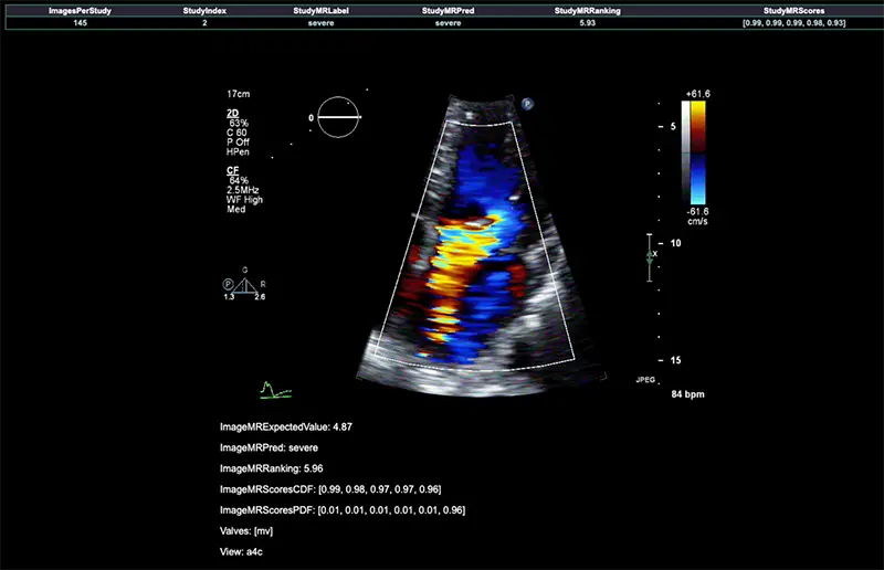 Echocardiogram showing severe mitral regurgitation
