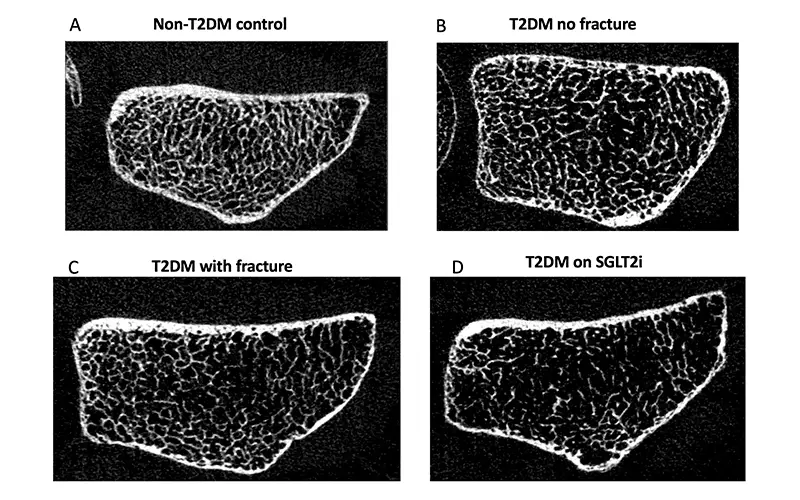 Images showing impact of type 2 diabetes on bone health