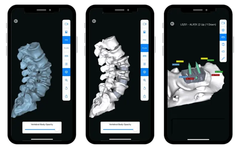 Phone displays ai-enabled software that generates personalized alignment plans and patient-specific designs.