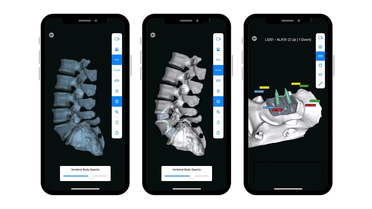 Phone displays ai-enabled software that generates personalized alignment plans and patient-specific designs.