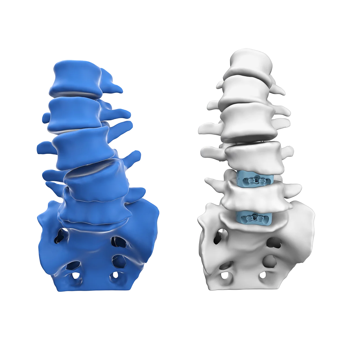 AI-generated patient-specific 3D spine models of a patient’s pre-operative spine (blue) and the personalized planned alignment (white)