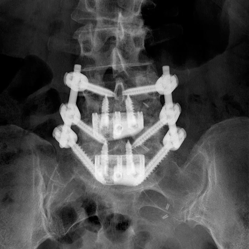 X-ray showing the interbody case implanted into a patient