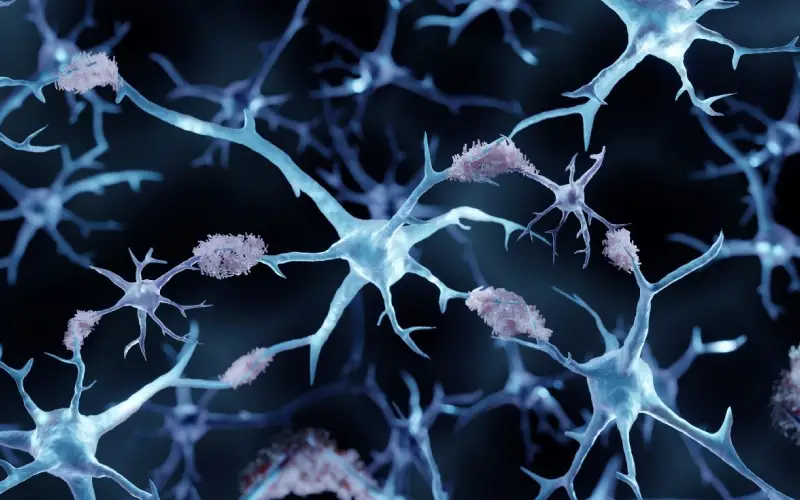 3D illustration showing amyloid plaques in Alzheimer’s disease