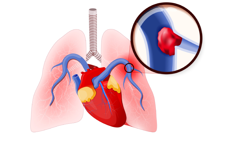 Illustration of pulmonary embolism