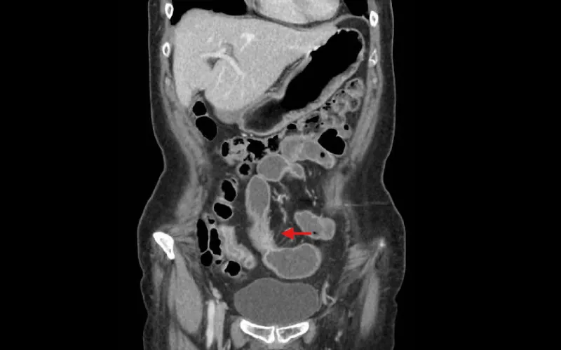 CT imaging showing fatty tissue