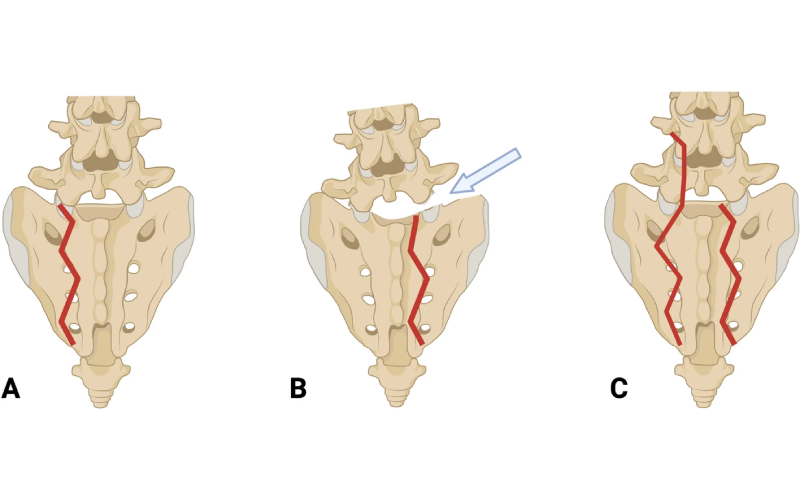 Three illustrations showing the classification for L5-S1 facet joint injuries.