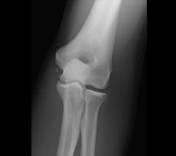 x-ray of ossification within UCL