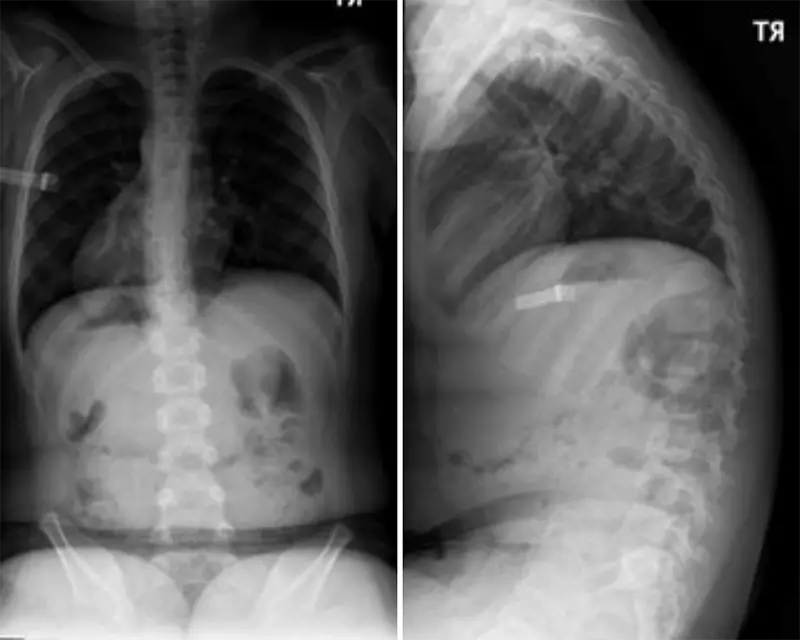 X-rays showing a left thoracic coronal curve of 13° and kyphosis of 77°