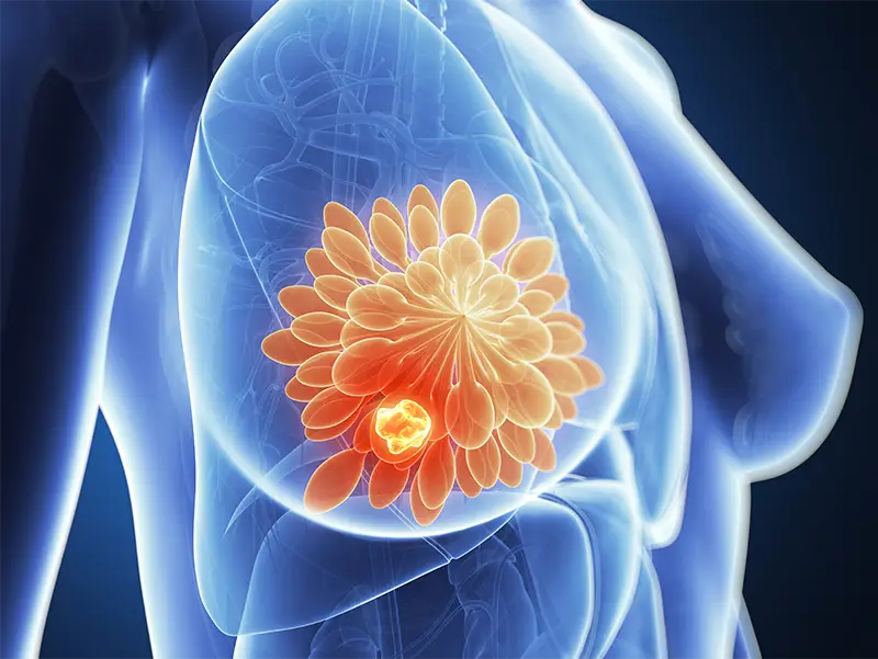 Illustration of the female body in blue with breast cancer abstract design in orange.