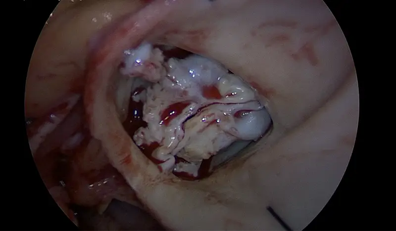 Severely stenotic aortic valve with extensive bulky leaflet calcium