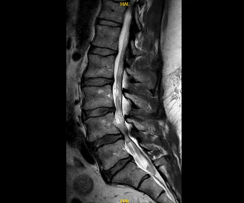 Pre-operative MRI showing severe spinal stenosis at L4-L5.