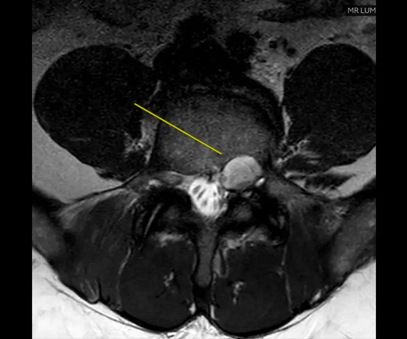 Pre-operative MRI showing the spinal tumor at L5/S1 on the left side.