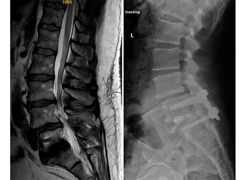 Post-operative MRI