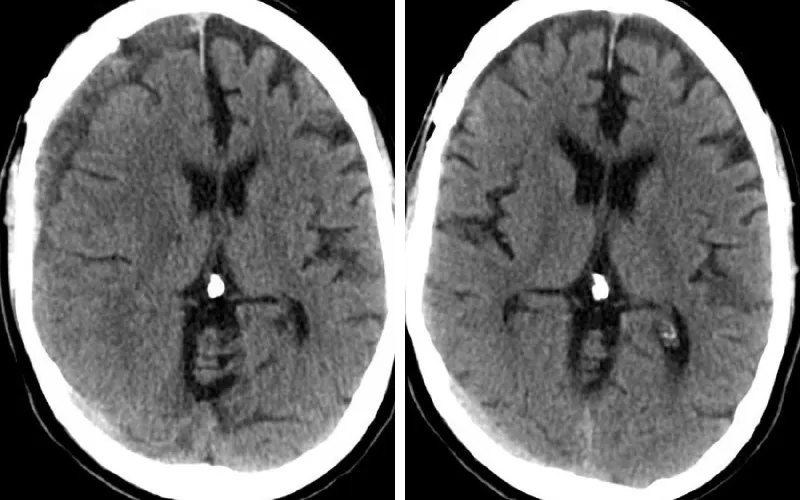 Subdural hematoma